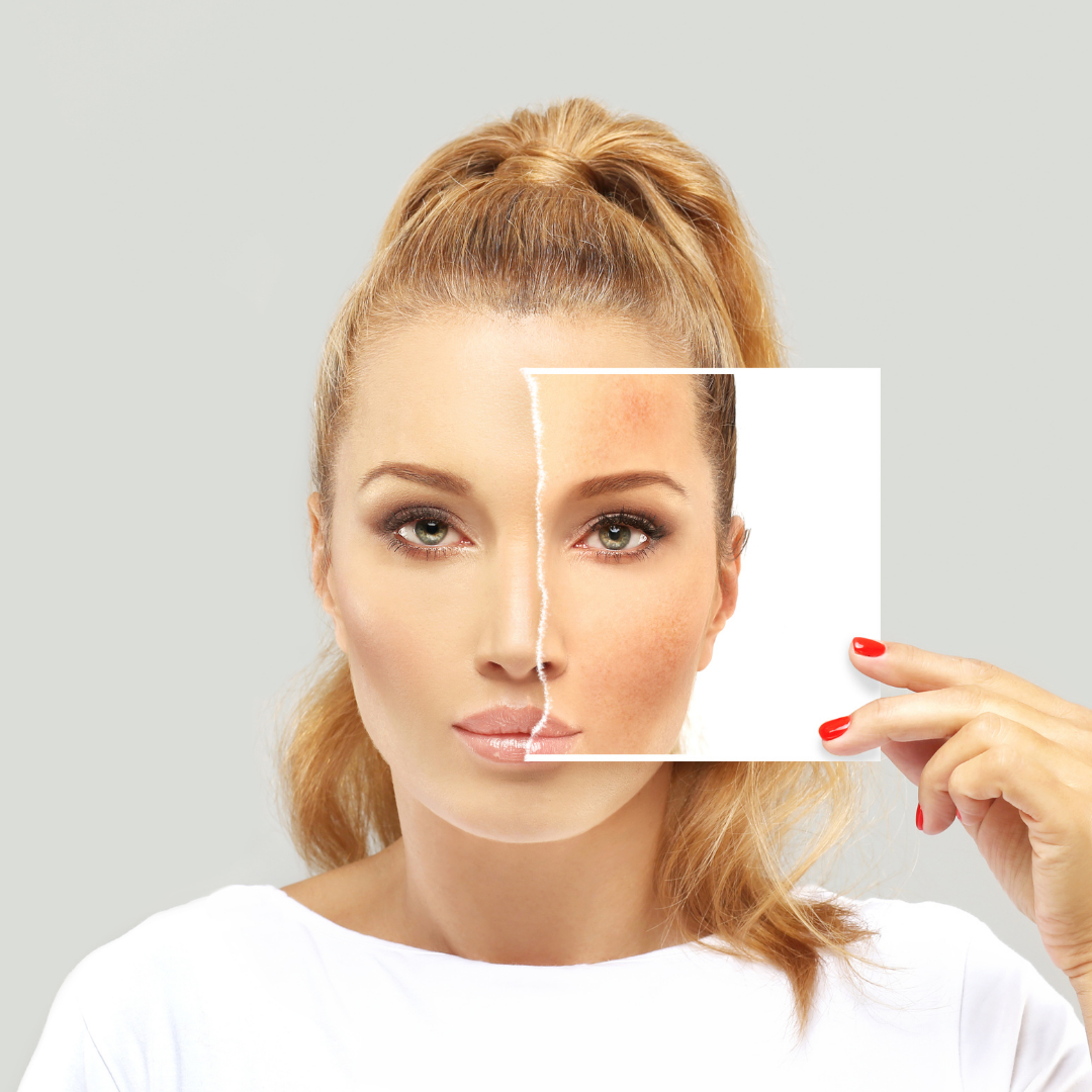 HOW DO SUNspots on the face go away? Evolvy