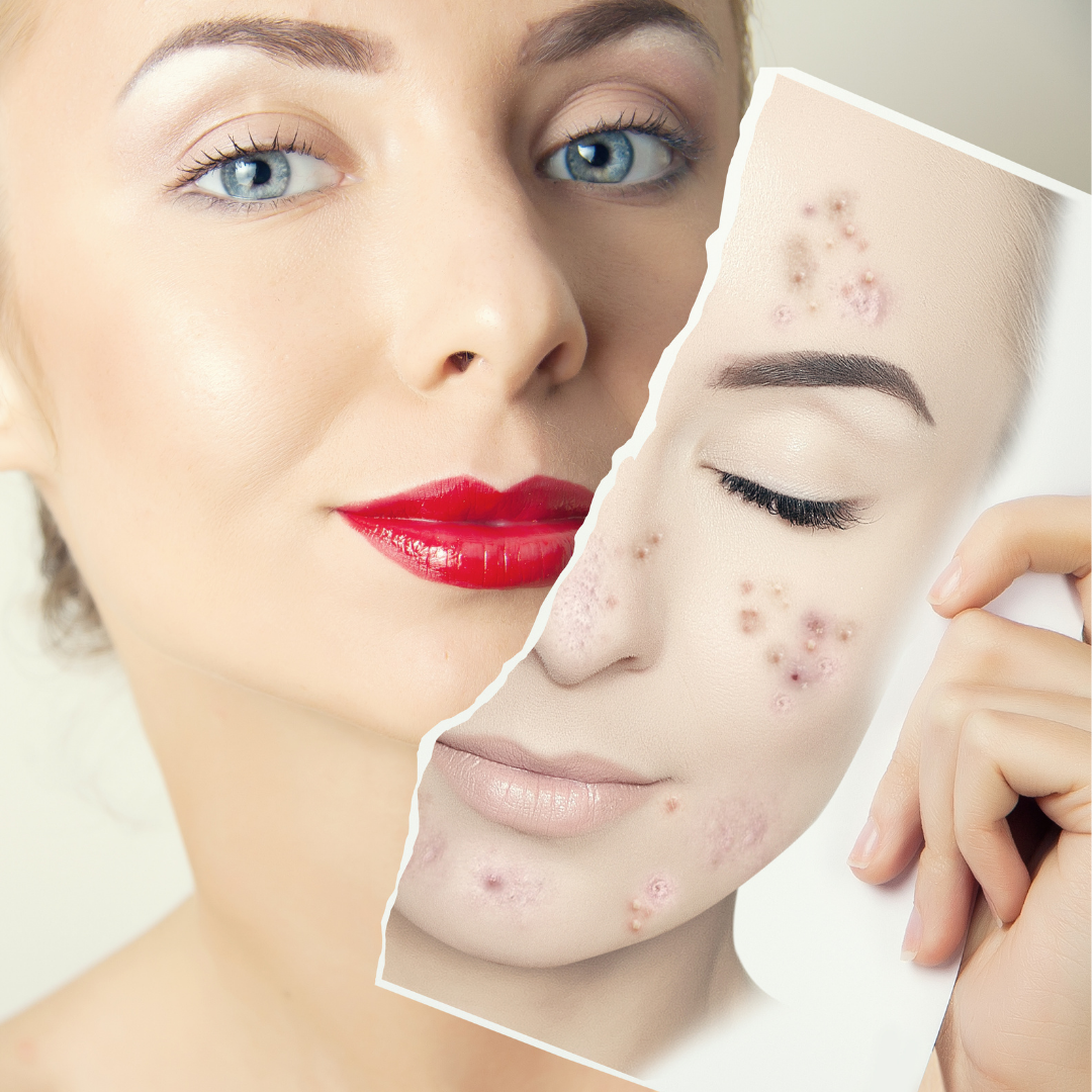 Cilt Lekelerine Ne İyi Gelir?