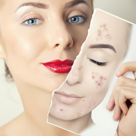 Cilt Lekelerine Ne İyi Gelir?