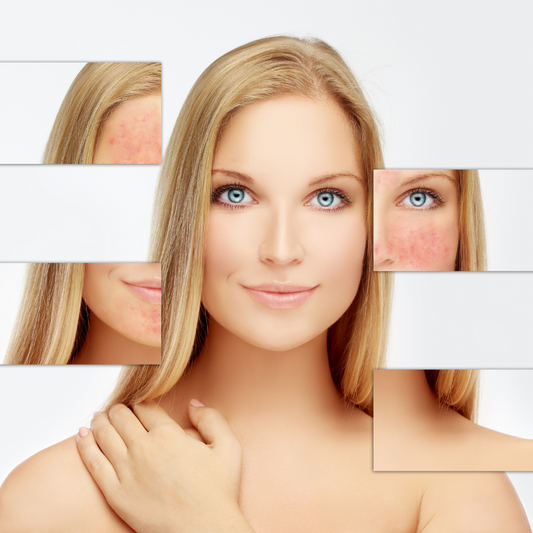 Roza (Gül) Hastalığı Nedir? Gül Hastalığının Tedavisi Var mı? Rozalı Ciltler için Cilt Bakım Önerileri