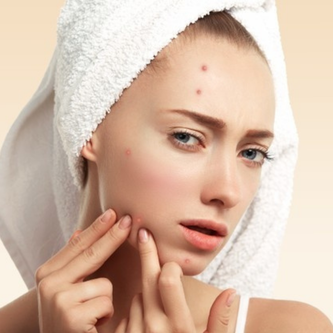 Akne Nedir ve Neden Oluşur?