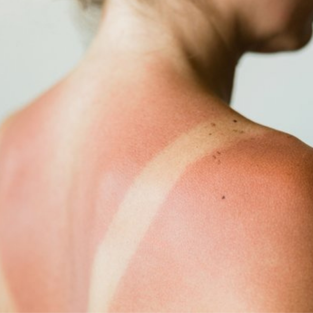 Güneş Yanığı Nasıl Geçer? Güneş Yanığından Nasıl Korunabilirsiniz?