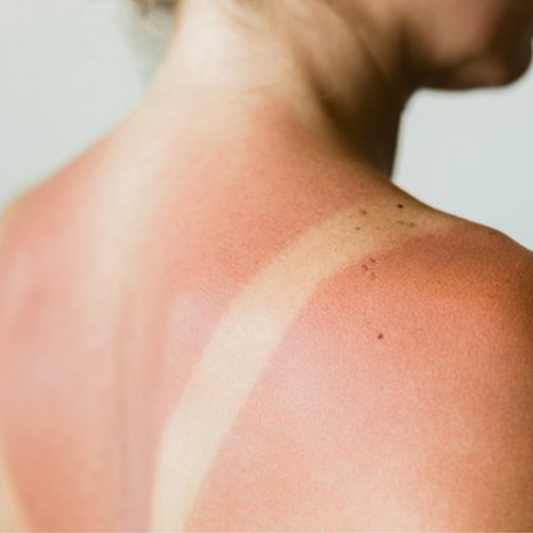 Güneş Yanığı Nasıl Geçer? Güneş Yanığından Nasıl Korunabilirsiniz?